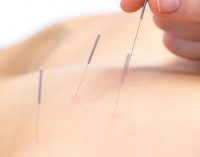 9 Things to Request Your Acupuncture Specialist