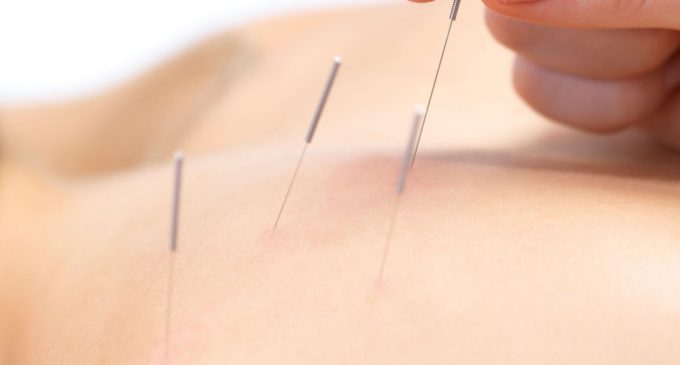 9 Things to Request Your Acupuncture Specialist