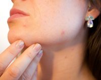 How to get rid of acne and pimples?