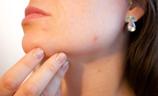How to get rid of acne and pimples?