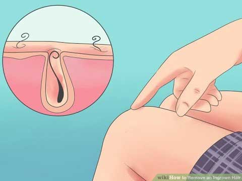 Ingrown-hair-are-not-removed-with-Laser-Hair-Removal