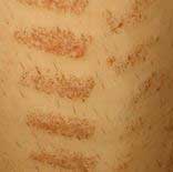 Laser-Treatment